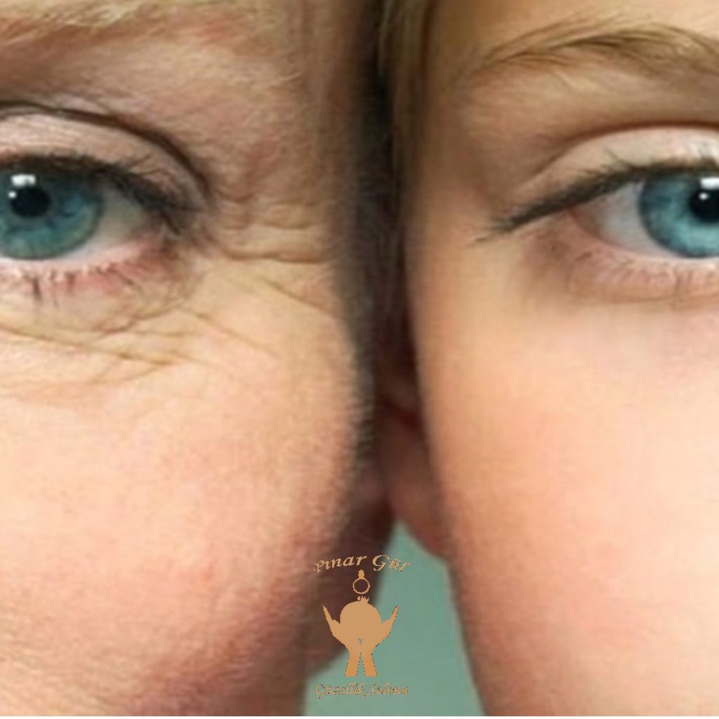 kırışıklık giderme yenikent güzellik salonu pınar gül