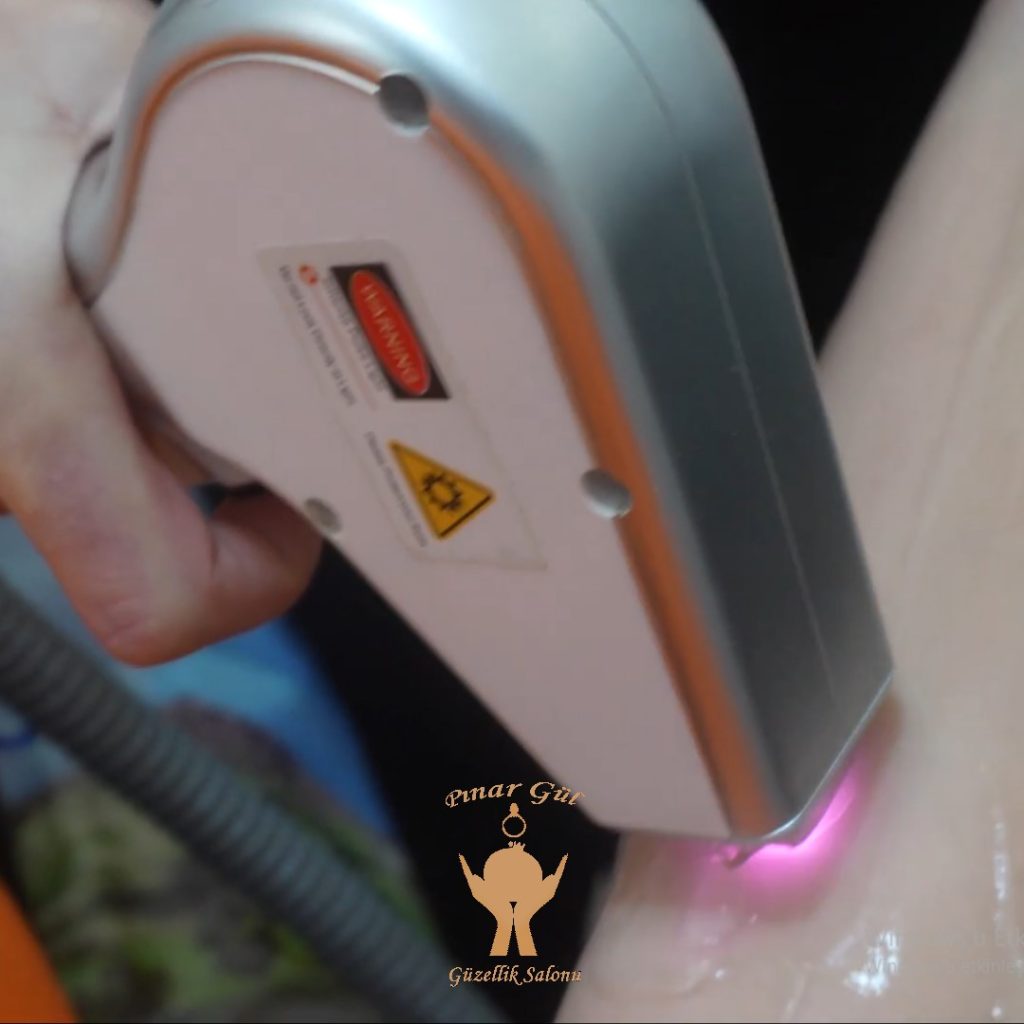 yenikent lazer epilasyon