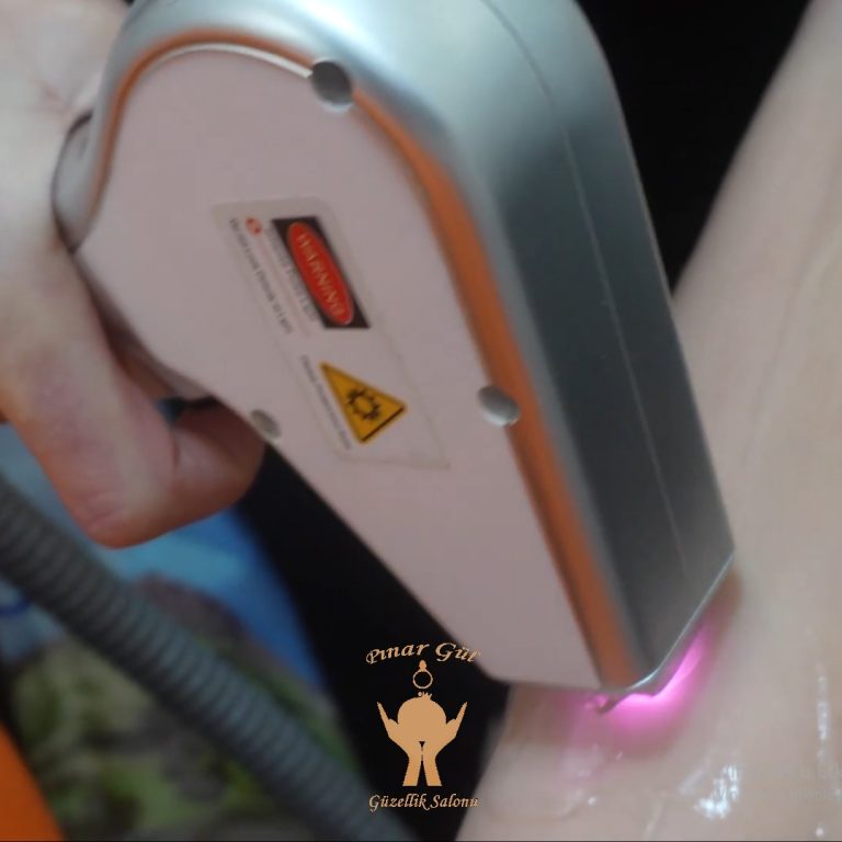 yenikent lazer epilasyon